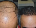 Surgical hair transplant