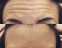 Forehead Wrinkles Botox